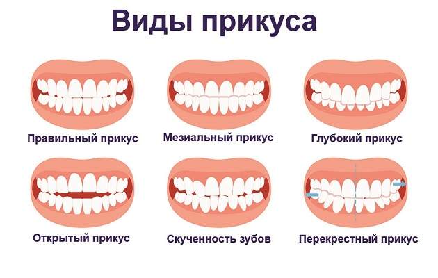 Типы прикуса