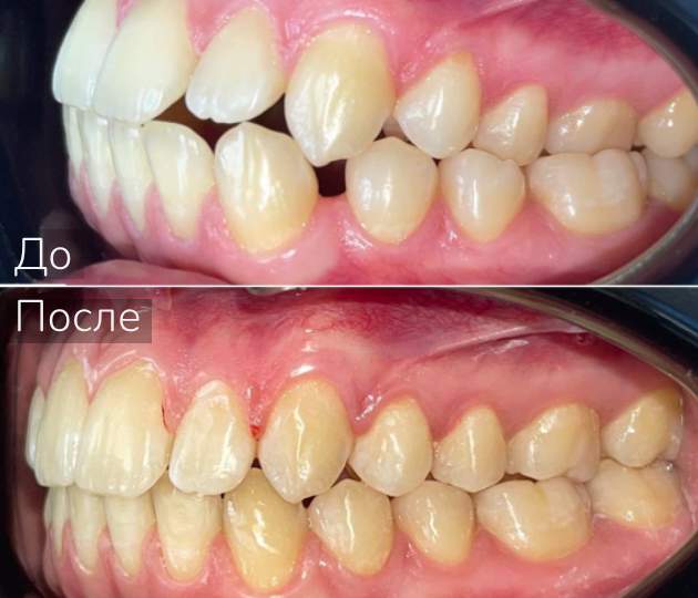 Перекрестный прикус