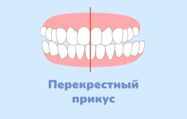 Перекрестный прикус