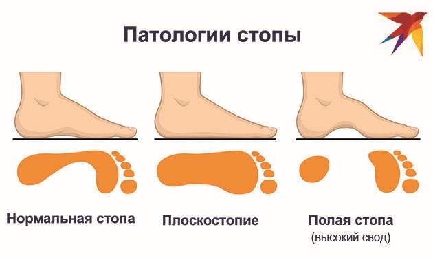 Патологии стопы