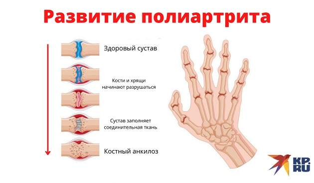 Полиартрит