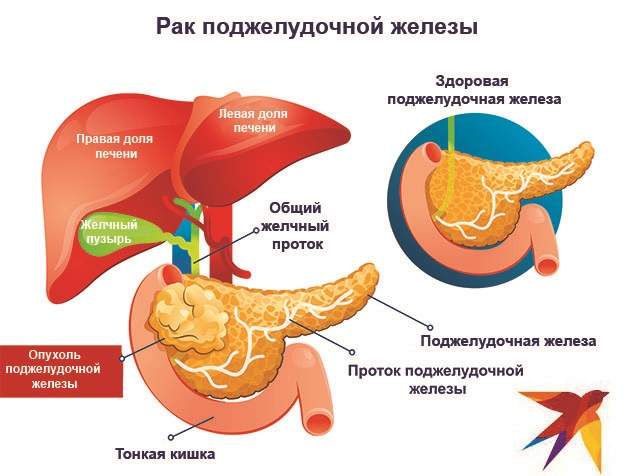 Рак поджелудочной железы