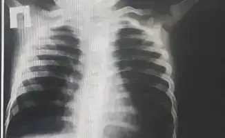 Туркестан: Операция на ребенке с инородным предметом в пищеводе подчеркивает важность бдительности родителей