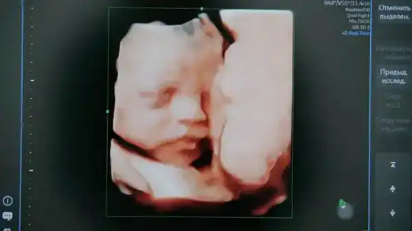 Нейросети помогут врачам Карагандинской области выявлять редкую патологию плода (2)