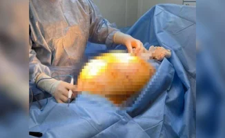 Гигантская тень: 25-килограммовая опухоль, как груз прошлого, была удалена у 68-летней пенсионерки в Алматы